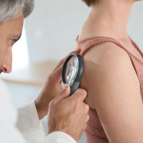 Da li treba preventivno uklanjati mladeže? Dermatolog otkriva pet znakova koji mogu da ukazuju na rak kože