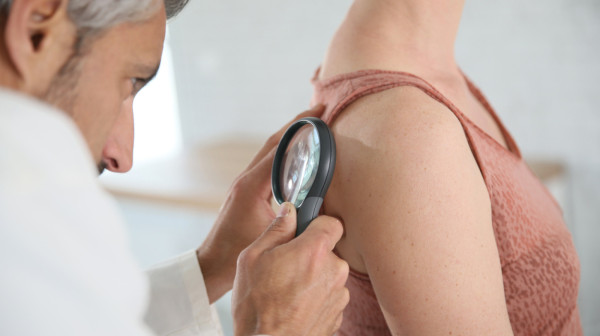 Da li treba preventivno uklanjati mladeže? Dermatolog otkriva pet znakova koji mogu da ukazuju na rak kože