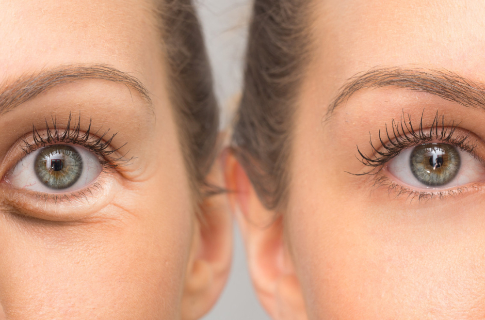 Rešite se tamnih i natečenih podočnjaka na prirodan način, lakše je nego što mislite