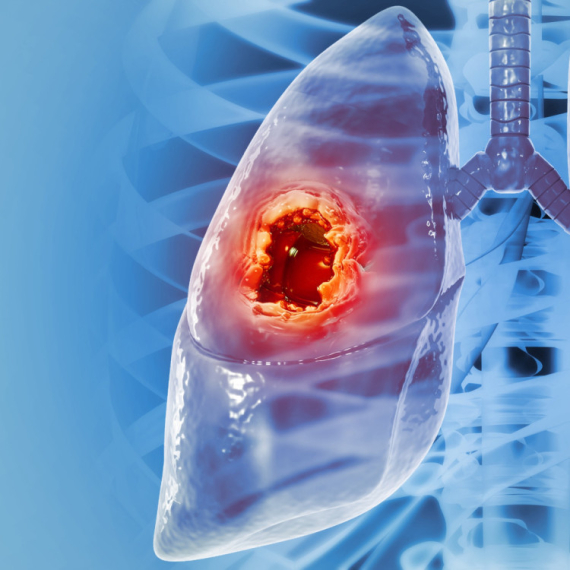 Crna statistika u Srbiji: Sve veći broj obolelih od raka pluća