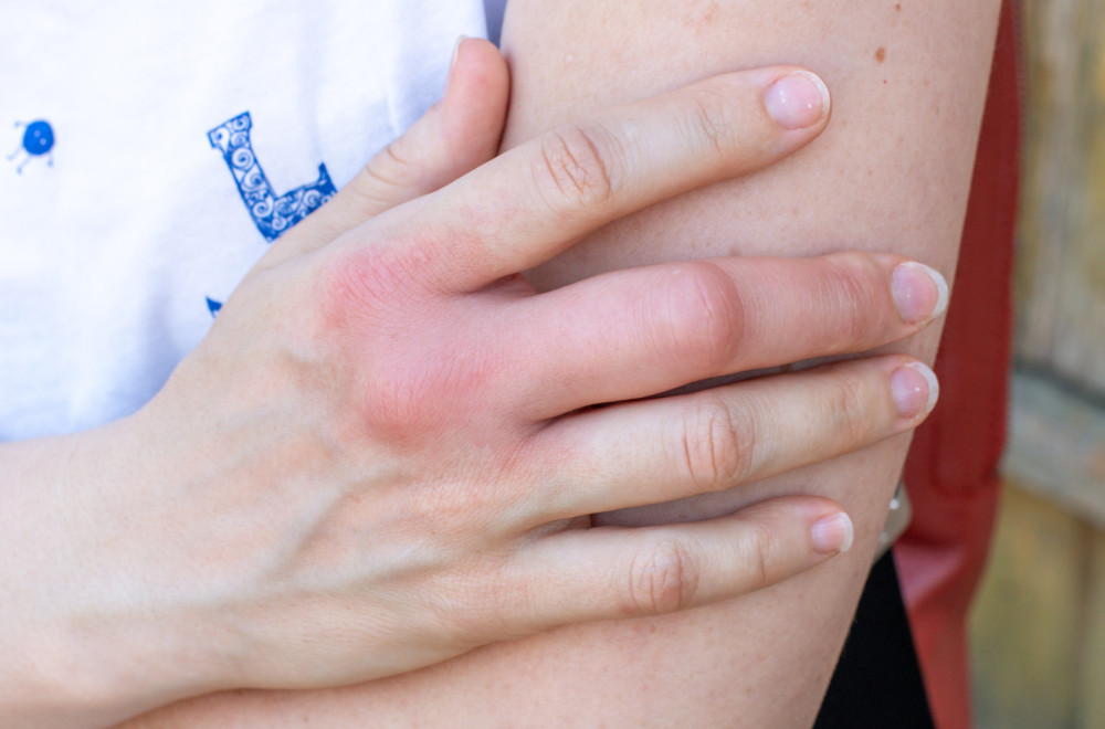 Spas kod ujeda ose, pčele ili stršljena: Stavite ovo na mesto uboda, nestaće i bol i otok