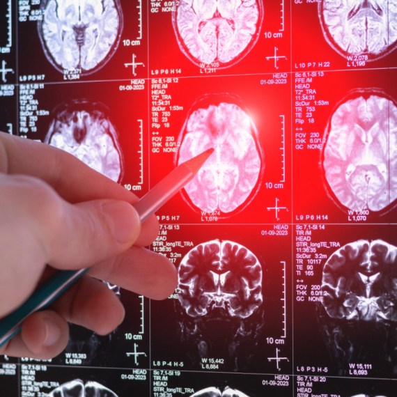 Nije svaka glavobolja rak mozga: Lekar upozorava kada je vreme da potražite pomoć