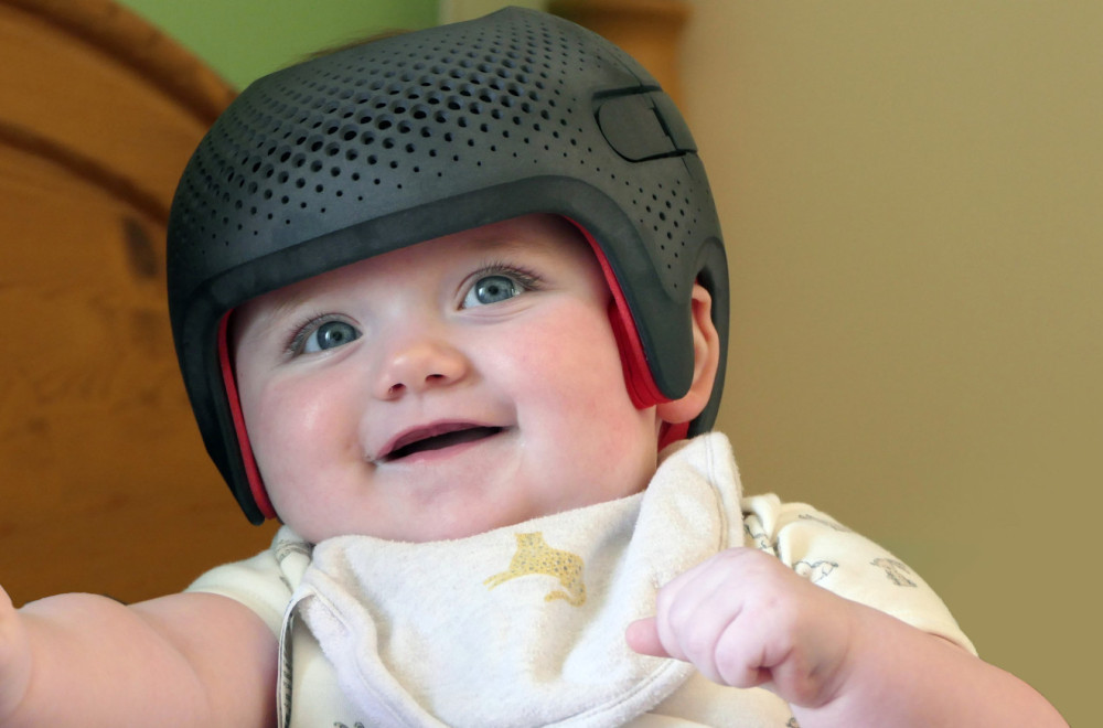 Mamu napali jer njene bebe nose kacige za oblikovanje glave: Morala je da se pravda VIDEO