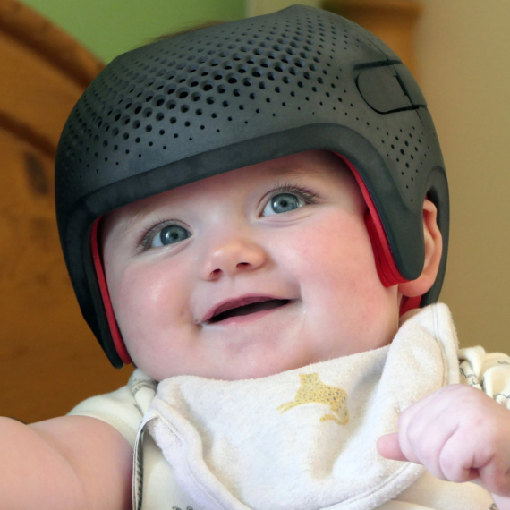 Mamu napali jer njene bebe nose kacige za oblikovanje glave: Morala je da se pravda VIDEO