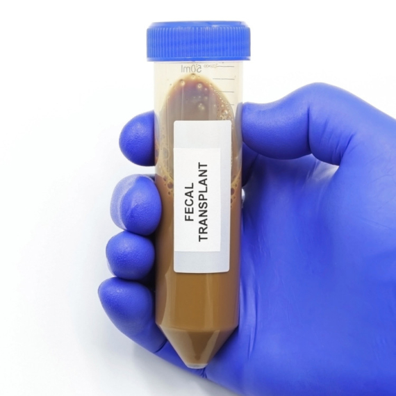 Švedska bolnica traži donore fekalija: Izmet u kapsulama novi način lečenja?