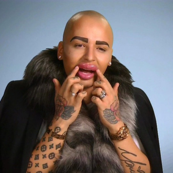 "Kralj usana" umro zbog silikona: Jeziva smrt muškarca koji je izgledao kao Kim Kardašijan