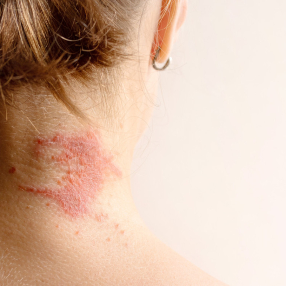 Kad svaki dodir peče: Dermatolog savetuje kako se boriti sa atopijskim dermatitisom VIDEO