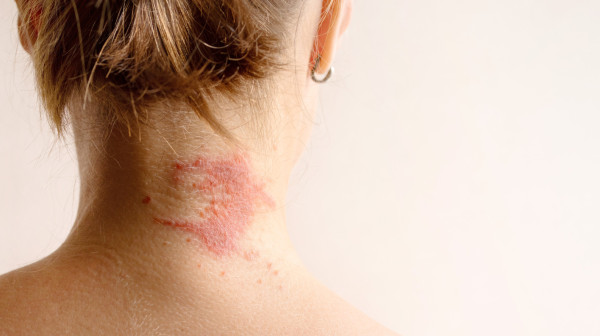 Kad svaki dodir peče: Dermatolog savetuje kako se boriti sa atopijskim dermatitisom VIDEO