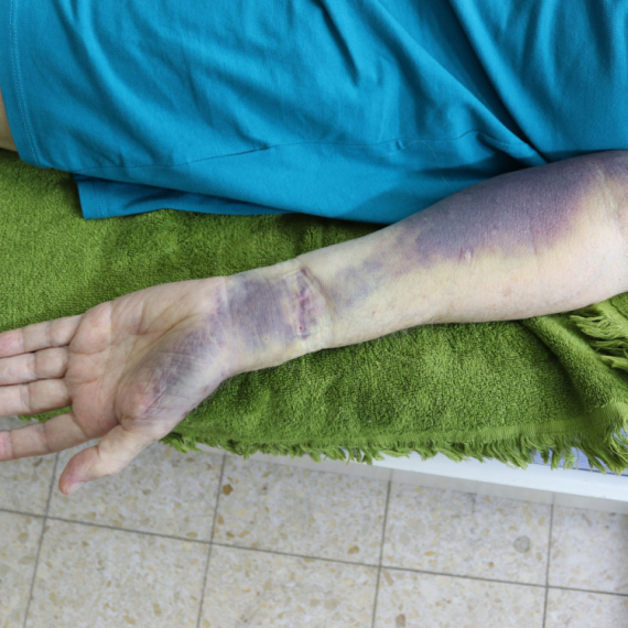 Vrućine povećavaju rizik od tromboze: Doktor otkriva ko je najugroženiji i kako da se zaštitite VIDEO