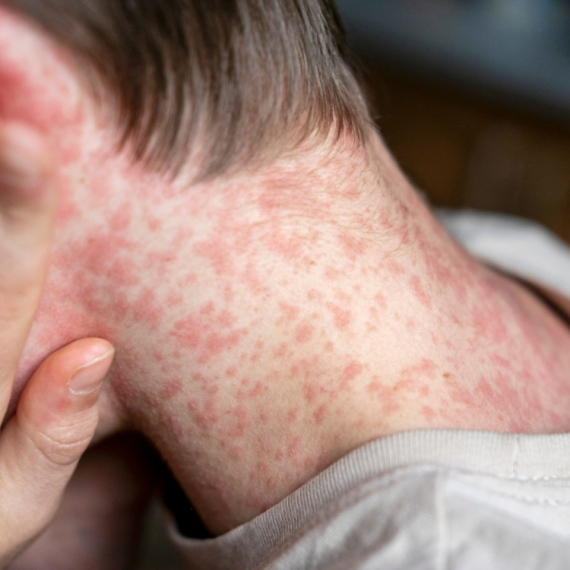 "Nije moguće okončati epidemiju malih boginja": Globalna pretnja po javno zdravlje