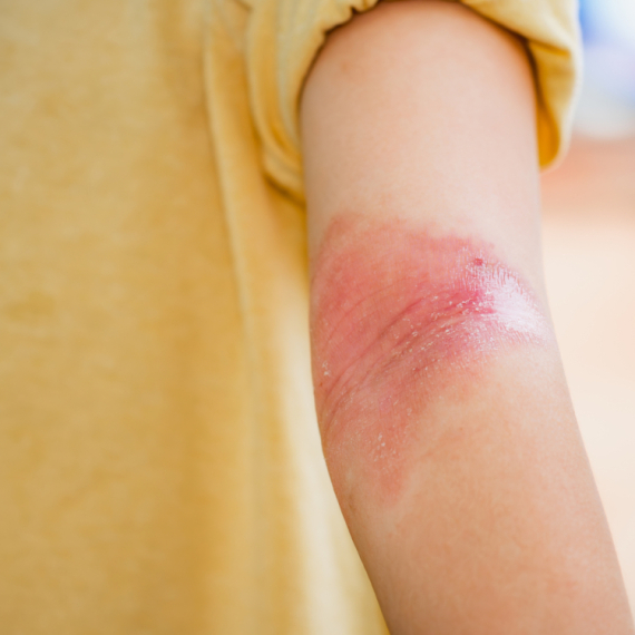 "Nije svako crvenilo atopijski dermatitis"; Doktorka otkrila najčešću grešku u lečenju
