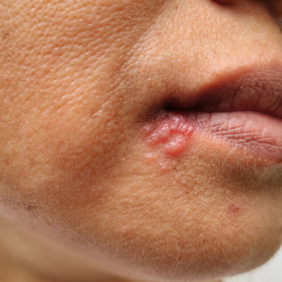 Virus koji milioni iaju: Herpes može da napravi haos u mozgu, čak i najteže bolesti